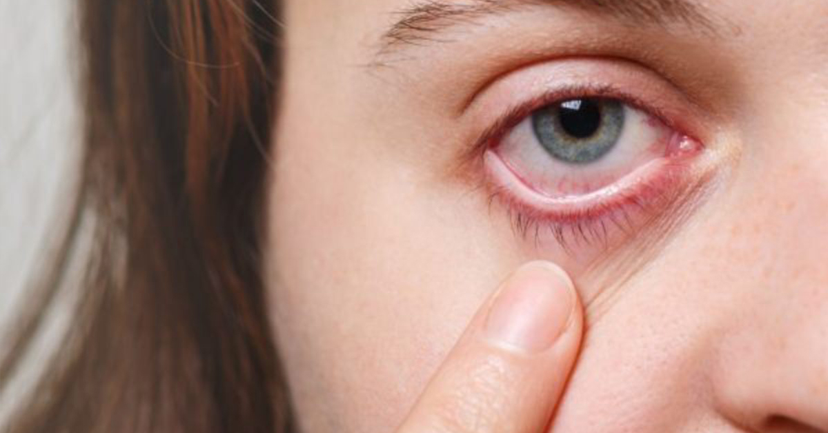 Brasil tem alto índice de alergia, diz OMS. - Eduardo Paulino