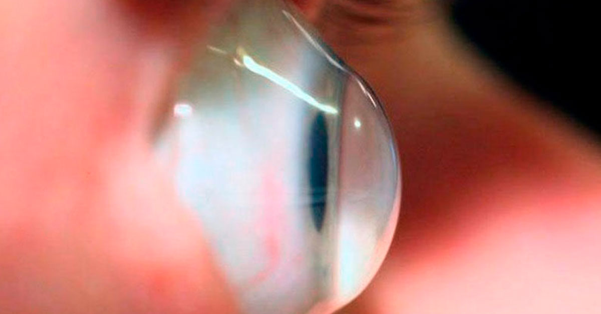 Ceratocone – Doença ocular deforma a córnea e pode causar sérios danos à visão. - Eduardo Paulino