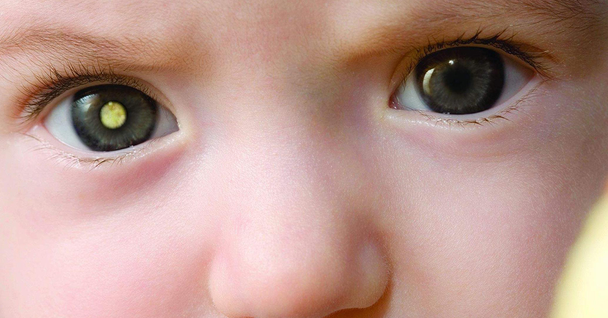 Retinoblastoma: tumor ocular em crianças - Eduardo Paulino