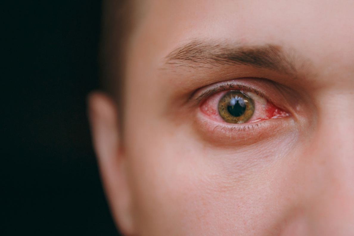 Casos de sífilis ocular aumentam no Brasil. - Eduardo Paulino